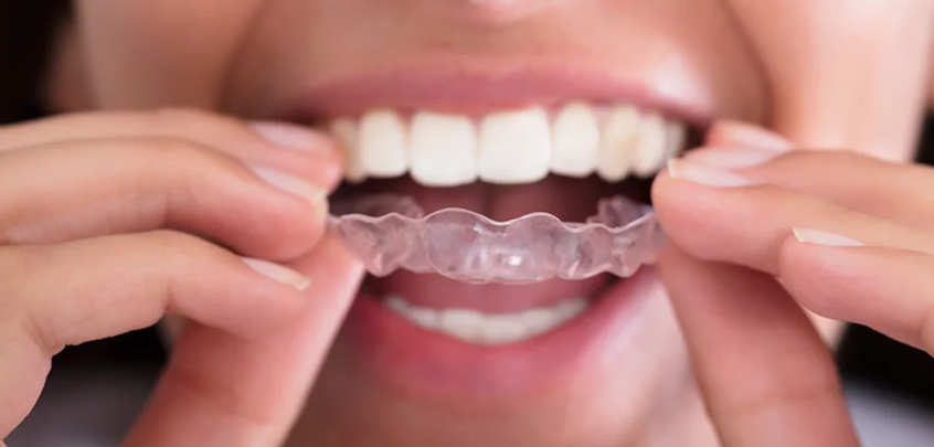 Person holding a clear dental aligner with their mouth open